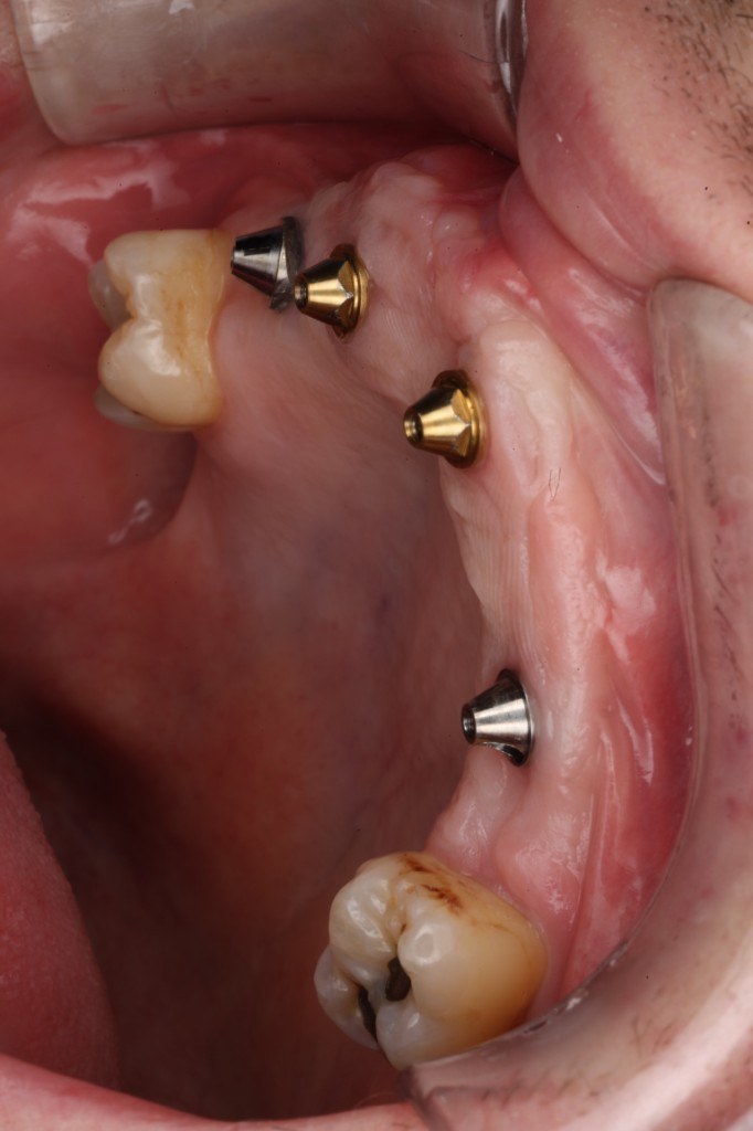 Dental implant treatment — Keystone Dental Studio