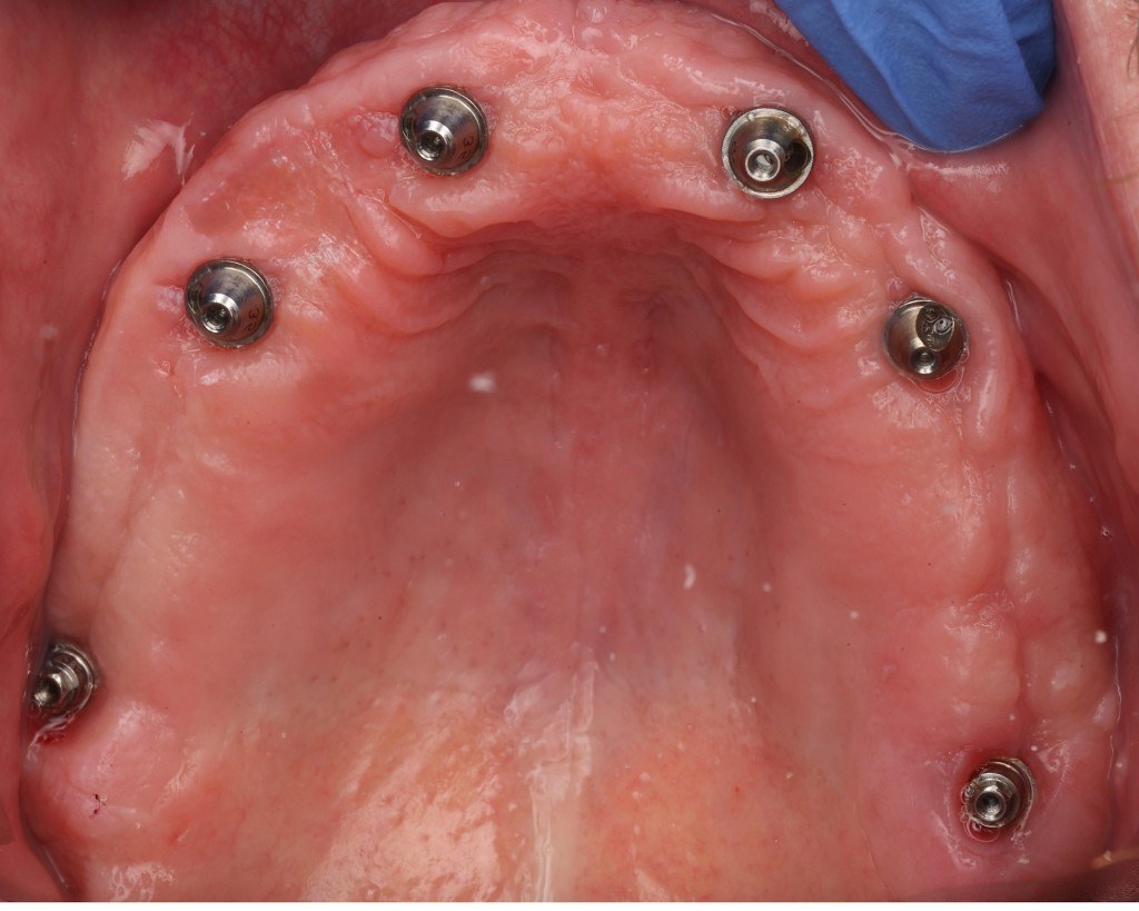 Full-arch dental implants — Keystone Dental Studio