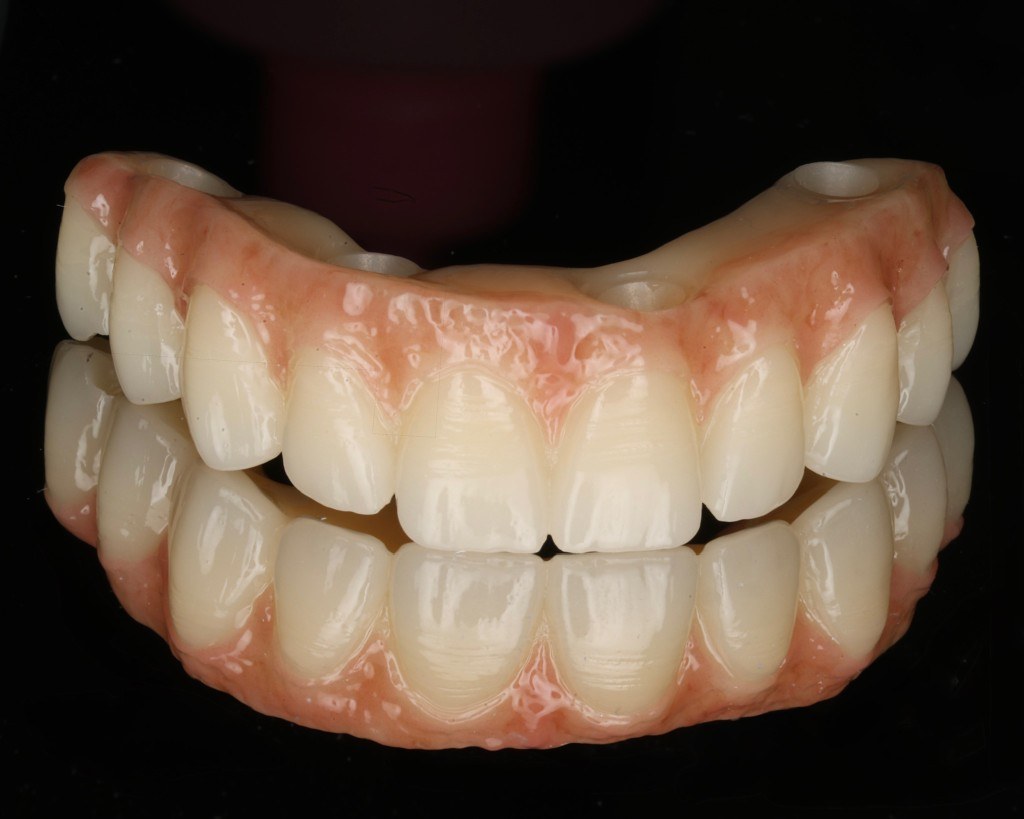 Full-arch dental implant result — Keystone Dental Studio