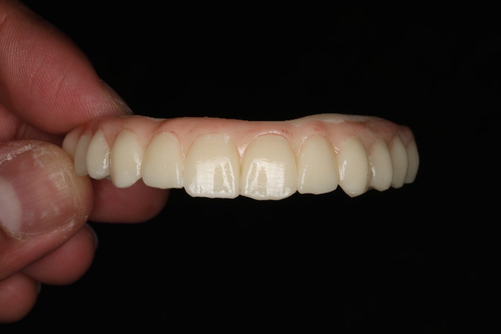 Implant-supported restoration — Keystone Dental Studio