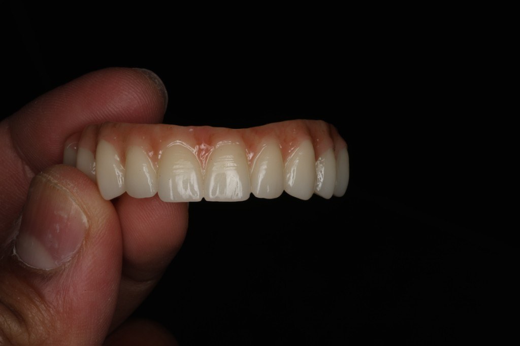 Implant-supported restoration — Keystone Dental Studio