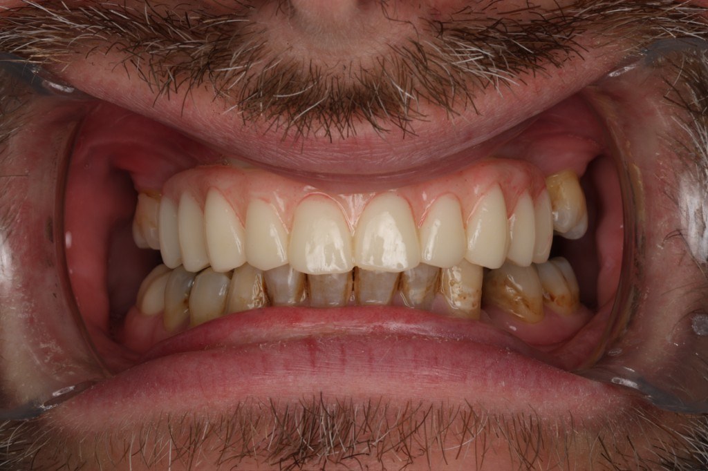 Dental implant smile result — Keystone Dental Studio