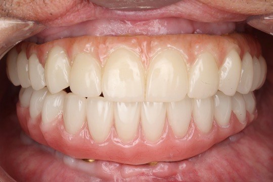 Smile result — Keystone Dental Studio, Reading PA