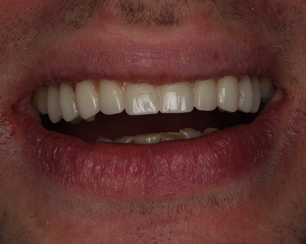 Cosmetic smile result — Keystone Dental Studio