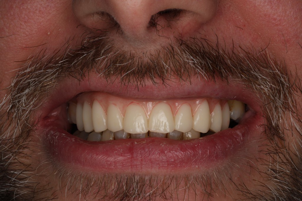 Smile result — Keystone Dental Studio, Reading PA