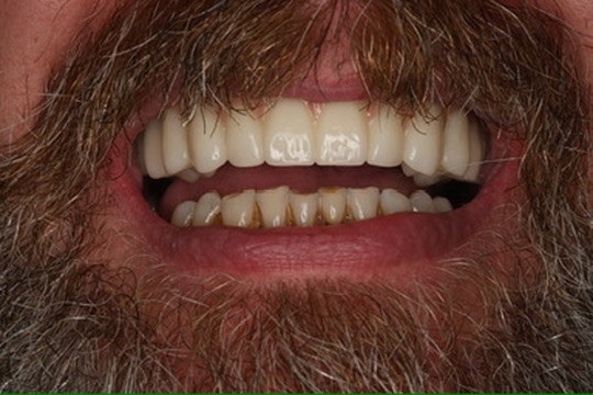 Cosmetic smile result — Keystone Dental Studio