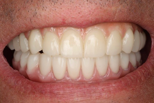 Smile result — Keystone Dental Studio, Reading PA