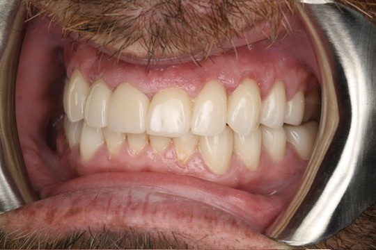 Smile result — Keystone Dental Studio, Reading PA