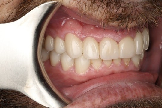Smile makeover result — Keystone Dental Studio