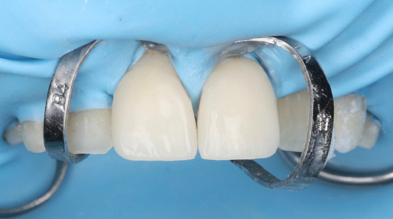 Porcelain veneers in progress — Keystone Dental Studio