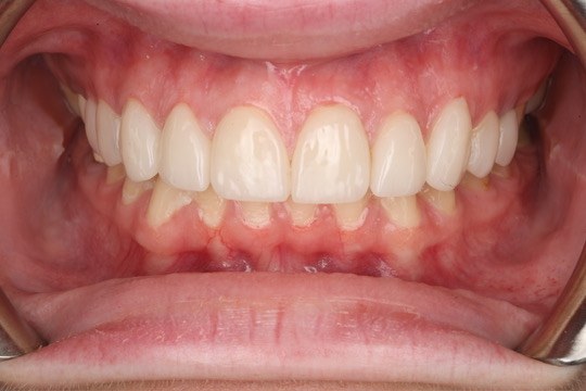 Smile makeover — Keystone Dental Studio