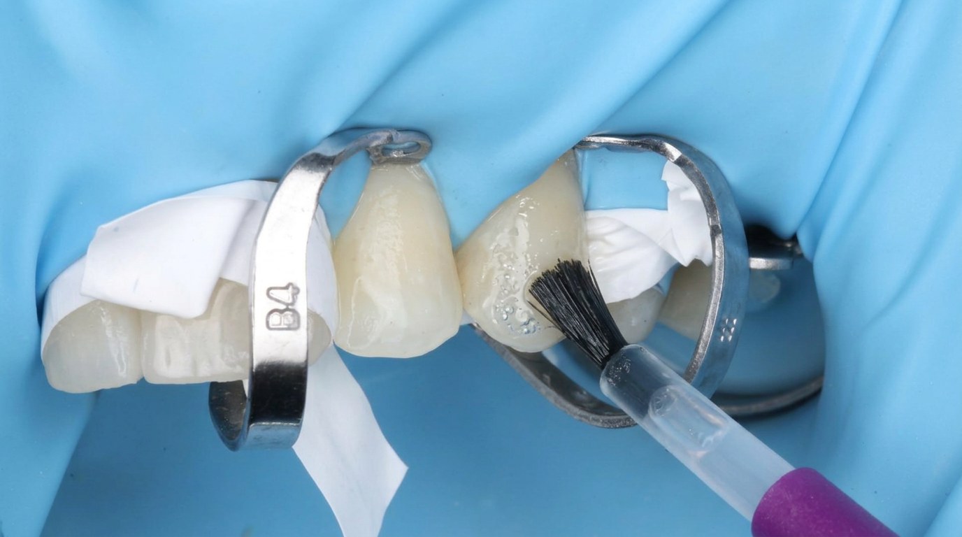Cosmetic shade matching — Keystone Dental Studio